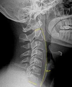 After Neck X Ray