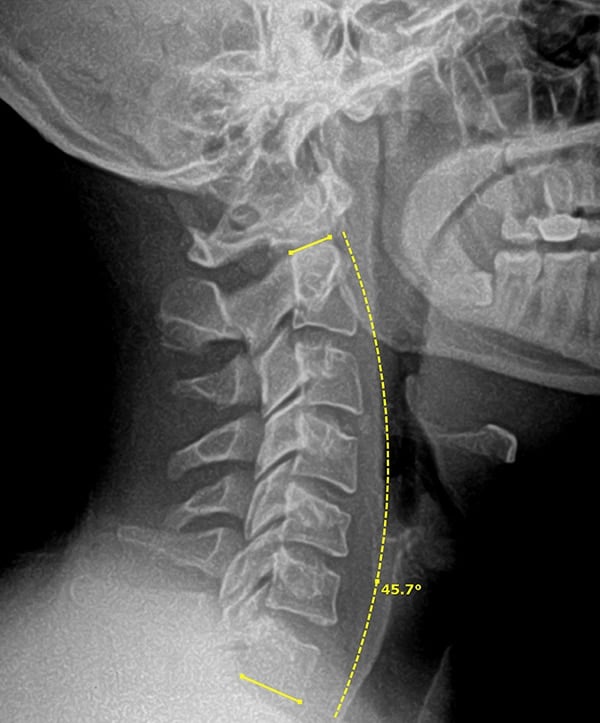AfterNeck