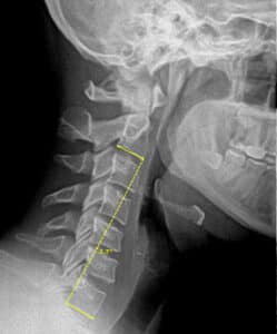 Before Neck X Ray